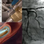 angiogram risk of death